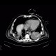 Pneumonia, pleural effusion, correlation: CT - Computed tomography