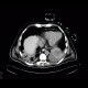 Pneumonia, pleural effusion, correlation: CT - Computed tomography