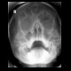 Sinusitis: X-ray - Plain radiograph