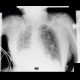 Pneumothorax: X-ray - Plain radiograph