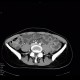 Terminal ileitis: CT - Computed tomography