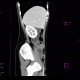 Terminal ileitis: CT - Computed tomography