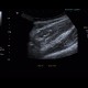 Terminal ileitis: US - Ultrasound