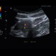 Terminal ileitis: US - Ultrasound