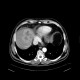Liver metastases of carcinoid, embolization: CT - Computed tomography