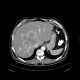 Liver metastases of carcinoid, embolization: CT - Computed tomography