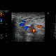 Thrombosis of femoral vein: US - Ultrasound