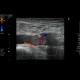 Thrombosis of femoral vein: US - Ultrasound