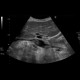 Thrombosis of inferior vena cava: US - Ultrasound