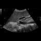 Thrombosis of inferior vena cava: US - Ultrasound