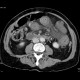 Thrombosis of mesenteric and portal vein, venous infarction of small bowel loops: CT - Computed tomography