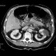 Thrombosis of mesenteric and portal vein, venous infarction of small bowel loops: CT - Computed tomography