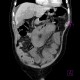 Thrombosis of mesenteric and portal vein, venous infarction of small bowel loops: CT - Computed tomography