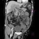 Thrombosis of mesenteric and portal vein, venous infarction of small bowel loops: CT - Computed tomography