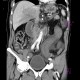 Thrombosis of mesenteric and portal vein, venous infarction of small bowel loops: CT - Computed tomography