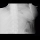 Colitis, thumbprinting: X-ray - Plain radiograph