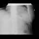 Colitis, thumbprinting: X-ray - Plain radiograph