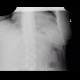 Colitis, thumbprinting: X-ray - Plain radiograph