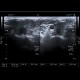 Thyreoiditis: US - Ultrasound