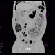 Toxic megacolon, pneumoperitoneum: CT - Computed tomography