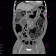 Toxic megacolon, pneumoperitoneum: CT - Computed tomography