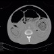 Toxic megacolon, pneumoperitoneum: CT - Computed tomography