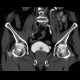 Trabecular hypertrophy of bladder, trabeculated bladder, pseudodiverticula: CT - Computed tomography