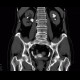 Trabecular hypertrophy of bladder, trabeculated bladder, pseudodiverticula: CT - Computed tomography