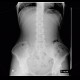 Colonic transit time, delayed: RF - Fluoroscopy