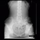 Colonic transit time, delayed: RF - Fluoroscopy
