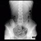 Colonic transit time, delayed: RF - Fluoroscopy