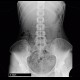 Colonic transit time, delayed: RF - Fluoroscopy