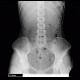 Colonic transit time, delayed: RF - Fluoroscopy