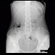 Colonic transit time, delayed: RF - Fluoroscopy