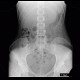 Colonic transit time, delayed: RF - Fluoroscopy