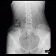 Colonic transit time, delayed: RF - Fluoroscopy
