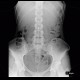 Colonic transit time, delayed: RF - Fluoroscopy