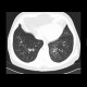 Tree in bud pattern, infectious bronchiolitis: CT - Computed tomography