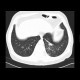 Tree in bud pattern, infectious bronchiolitis: CT - Computed tomography