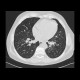 Tree in bud pattern, infectious bronchiolitis: CT - Computed tomography