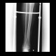 Trimalleolar fracture, subluxation in talocrural joint: X-ray - Plain radiograph