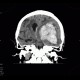 Cerebral hemorrhage, hypertonic hemorrhage, hemocephalus, subfalcine herniation, descendent transtentorial herniation: CT - Computed tomography