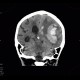 Cerebral hemorrhage, hypertonic hemorrhage, hemocephalus, subfalcine herniation, descendent transtentorial herniation: CT - Computed tomography