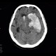 Cerebral hemorrhage, hypertonic hemorrhage, hemocephalus, subfalcine herniation, descendent transtentorial herniation: CT - Computed tomography