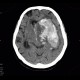 Cerebral hemorrhage, hypertonic hemorrhage, hemocephalus, subfalcine herniation, descendent transtentorial herniation: CT - Computed tomography