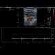 Trombembolus of axillary artery: US - Ultrasound