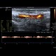 Trombembolus of axillary artery: US - Ultrasound