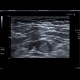 Trombembolus of axillary artery: US - Ultrasound