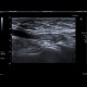 Trombembolus of axillary artery: US - Ultrasound