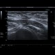 Trombembolus of axillary artery: US - Ultrasound